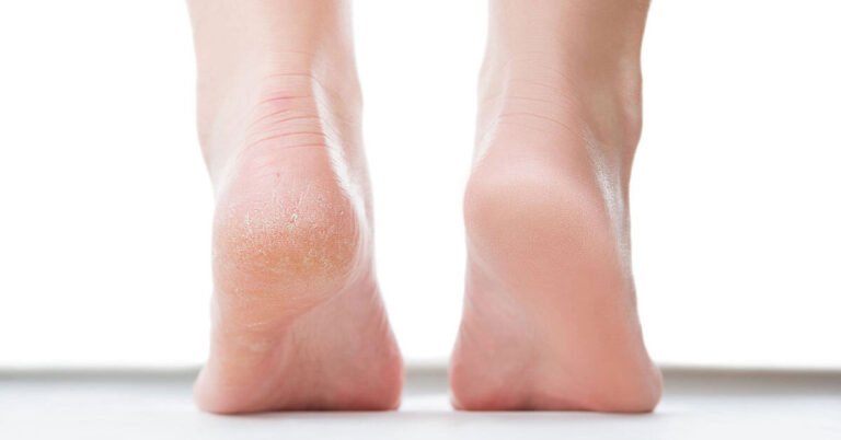 كيف أعالج تشقق الكعبين